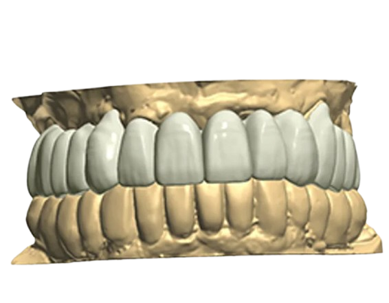 Full Contour Restorations