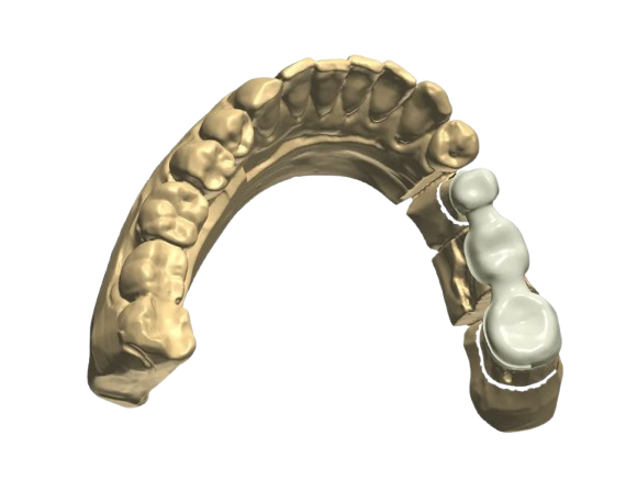 Lingual Collar Designs