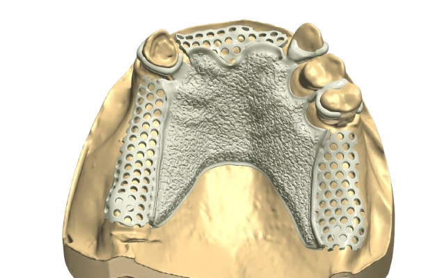RPD - Removable Partial Dentures